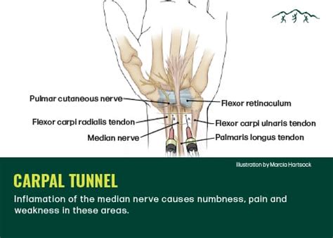 Common Video Game Injuries: Gamer’s Thumb, Wrist & Carpal .